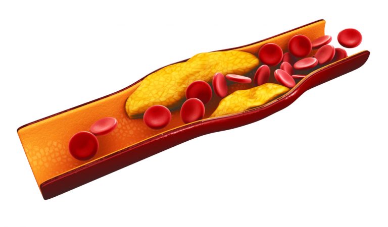 Cholesteroltheorie ongeloofwaardig na mislukte trial