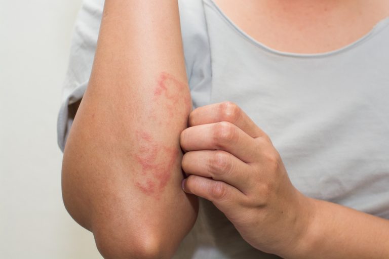 Psoriasis: meer kans op een hartaanval?