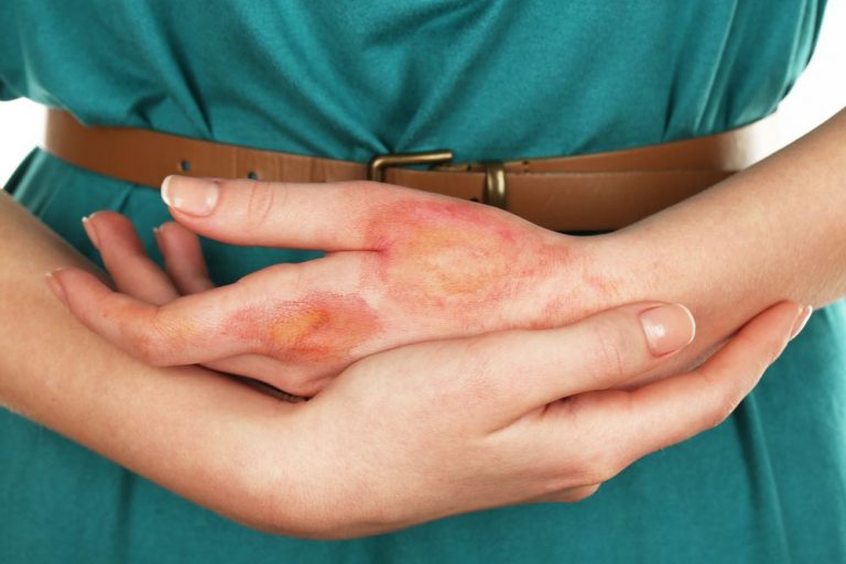 BMR vaccinatie kan huidproblemen en ontstekingen veroorzaken