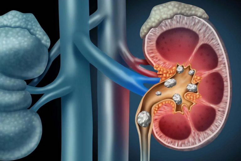 Ultrasone pulsen verbrijzelen nierstenen