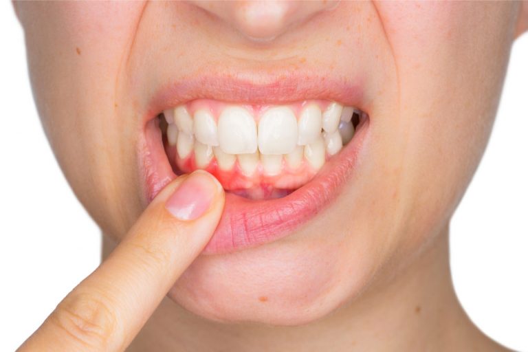 Tandvleesaandoeningen kunnen twee soorten kanker veroorzaken