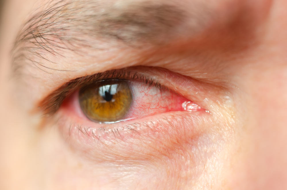 Herbruikbare contactlezen verhogen risico ooginfectie